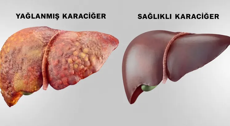 Sağlıklı bir karaciğerin yanında yağlanmış bir karaciğer